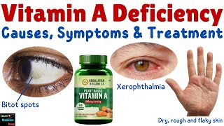 Vitamin A Deficiency – Causes Symptoms Diagnosis Treatment amp Prevention [upl. by Esilram]