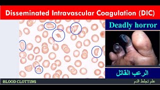 Lecture 24 Disseminated Intravascular Coagulation  DIC [upl. by Cadman]