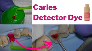 Is Caries Detector Dye BS Caries Removal investigated  PDP138 [upl. by Hudis]