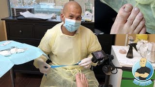 INGROWN TOENAIL SURGERY  How To Remove An Ingrown Toenail Forever POV [upl. by Llebanna]