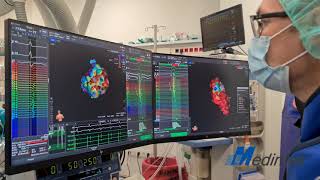 RHYTHMIA HDx 3D Mapping System with Lumipoint Directsense amp MIFI Technology [upl. by Eisenberg]