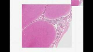 Histopathology Brain Acute pyogenic bacterial meningitis [upl. by Nawuq]