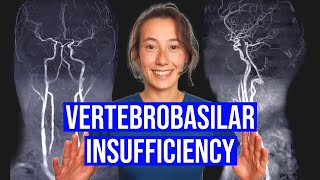 Vertebrobasilar Insufficiency VBI Test [upl. by Thomas]