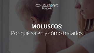 Moluscos qué los ocasiona y cómo tratarlos  Consultorio bbmundo [upl. by Belva]