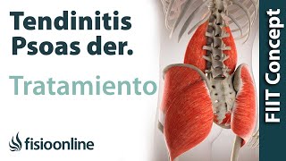 Tratamiento de la tendinitis del psoas derecho o psoitis derecha [upl. by Hamfurd567]