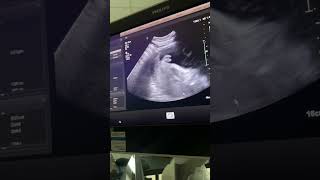 Sonogram appointment 37 weeks pregnant 🤰 [upl. by Ahtibbat]