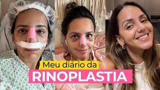 MINHA RINOPLASTIA pósoperatório doeu Meu diário de 12 dias com ANTES e DEPOIS  Prefiro Viajar [upl. by Tessie]