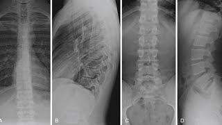 Darso Lumber spine x ray  x ray darsolumber spine  darsal spine x ray [upl. by Yerggoeg]