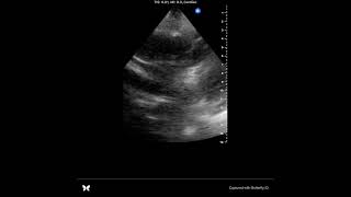 POCUS tamponade [upl. by Nnylesor]