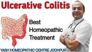 Ulcerative Colitis treatment ।IBS ।stomach pain।blood mucus in stool homeopathy Treatment [upl. by Shabbir]