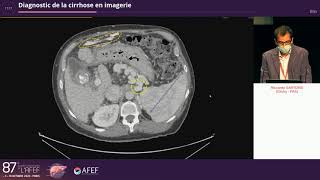 Diagnostic de la cirrhose en imagerie  R Sartoris [upl. by Liesa]