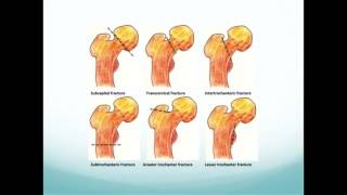 Hip Fractures The basics [upl. by Wiburg649]