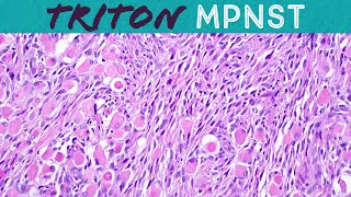 Malignant Triton tumor MPNST with rhabdomyosarcoma differentiation Basic soft tissue pathology [upl. by Nibram]