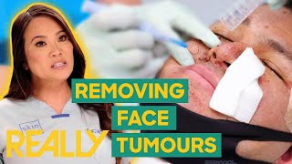 Dr Lee’s Patient Endures Uncomfortable Face Tumour Removal  Dr Pimple Popper Pop Ups [upl. by Grindlay135]