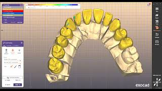 DENTAL CROWN REDUCED BRIDGE DESIGN FOR EXOCAD32 exocad [upl. by Maddis]