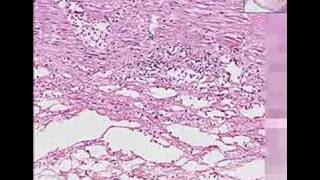 Histopathology ColonIschemic enterocolitis [upl. by Atikal637]