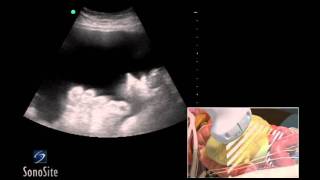 How To Ultrasound Guided Paracentesis Procedure 3D Video [upl. by Lirret]