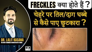 Freckles क्या होता हैं  चेहरे पर तिल दाग धब्बे से कैसे पाए छुटकारा  at Dr Kasana Clinic [upl. by Attoynek]