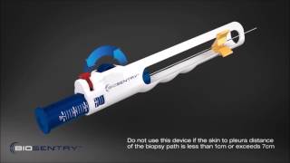 BioSentry™ tract sealant system [upl. by Feenah]