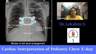 Chest Xray Focusing the CVS  Cardiac Interpretation of Pediatric Chest XRay Pediatric Webinar [upl. by Koeppel]