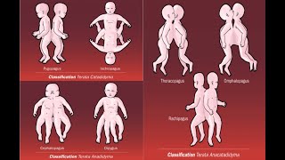 Types of conjoined conjoint twins  Omphalopagus Pygopagus Craniopagus Diprosopus Parapagus [upl. by Qidas]