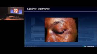 Cleveland Conference 2018 Ocular Sarcoidosis  Dr Sumit Sharma [upl. by Ahsinrev485]