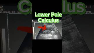 Non Obstructing Renal Stone  Lower pole stone  Kidney Calculus on Ultrasound [upl. by Shenan390]