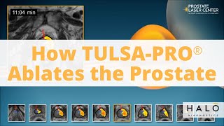 How TULSAPRO TransUrethral Ultrasound Ablation procedure Works as a Prostate Cancer Treatment [upl. by Julis662]