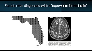 Florida man diagnosed with a tapeworm in the brain [upl. by Anialeh]