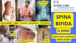 SPINA BIFIDA in Hindi  स्पाइना बिफिडा  कारण लक्षण व इलाज  Full Detailed Video  Extra Care [upl. by Sseb372]