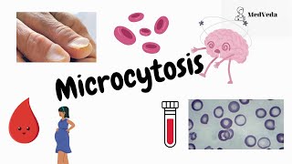 Microcytic Anemia  Definition  Symptoms  Causes  Pathophysiology Pathology [upl. by Gregoire202]