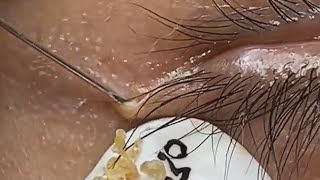 Extraction profonde des points noirs Acné kystique et popping 13 [upl. by Eneleahs439]