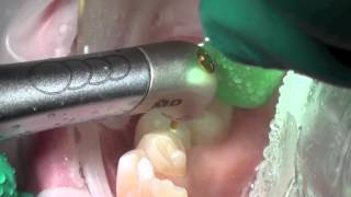 Occlusal Prep for Endo Access performed with Biolase iPlus AllTissue Laser [upl. by Dinah]