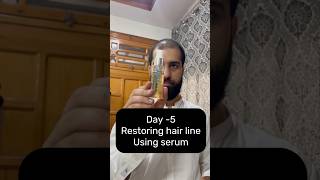 Restoring Hair Line Day5 using serum hairregrowth haircareroutine [upl. by Malinowski]