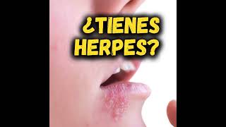 ¿TIENES HERPES 🧏🏻‍♀️ [upl. by Mosira206]