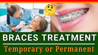 Is Braces Treatment Temporary or Permanent  ब्रेसेस उपचार अस्थायी है या स्थायी  Know Fact 😱 [upl. by Jordans]