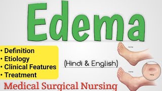 Edema  Edema In Hindi  Oedema [upl. by Nnateragram535]