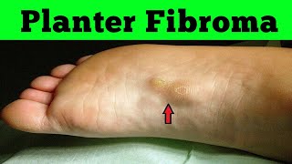 Planter fibromatosis on ultrasound Imaging [upl. by Edrahs]