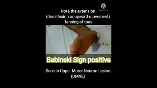 Babinski sign positive UMNL mbbs physiology medicine neetpg inicet aiims practical [upl. by Drallim]