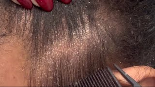 Flaky Eczema Scalp extreme close up ASMR [upl. by Yelnik926]