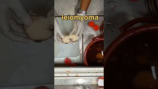 Leiomyoma smooth muscle tumour specimen லியோமியோமா [upl. by Kamp]