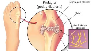 Podagra kasalligi haqida Подагра касаллиги [upl. by Leno]