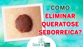 Como ELIMINAR Queratose Seborreica DESCUBRA [upl. by Sollie421]