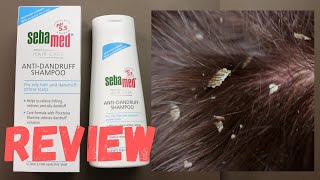 Best Dandruff Shampoo  Shampoo for seborrheic dermatitis  how to treat and control dandruff [upl. by Misti]