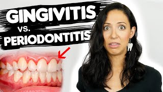 Do You Have Gingivitis or Periodontitis  Different Stages Of Gum Disease [upl. by Bithia928]