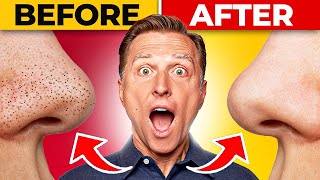 How To REMOVE Blackheads Permanently [upl. by Furtek713]