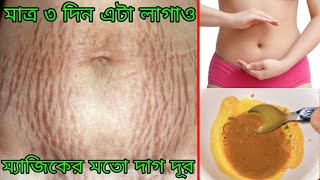 মাত্র ৩ দিন এটা লাগাও ম্যাজিকের মতো গর্ভকালীন ফাটা দাগ ও স্ট্রেচ মার্ক গোড়া থেকে দূর হবে [upl. by Anabelle]