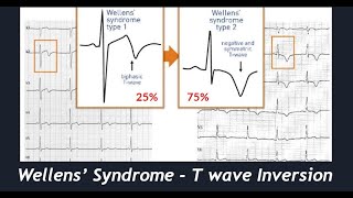 The EKG of Wellens Syndrome and T wave inversion differentials I The Pacemaker [upl. by Jeffery]