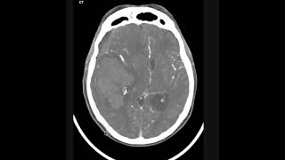 Intraparenchymal hemorrhage [upl. by Milah]