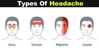 Different Types Of Headache  SignSymptomps and Treatments UrduHindi [upl. by Nibram]